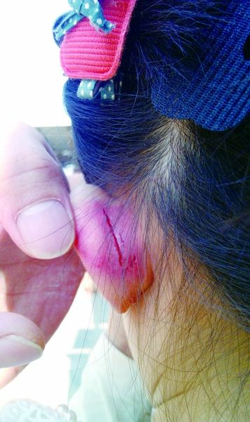 　　女童的耳朵被老師揪裂。圖片由女童家人提供