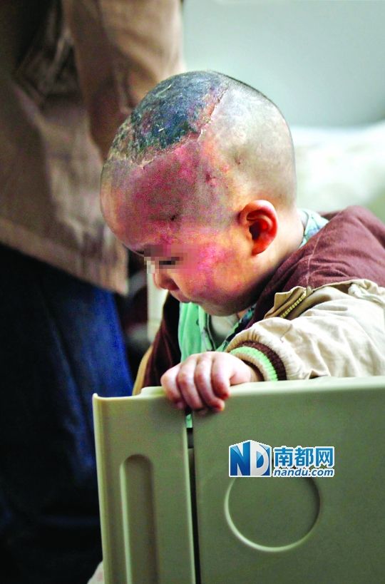 1月8日下午，小寶頭上和臉上都是傷痕。