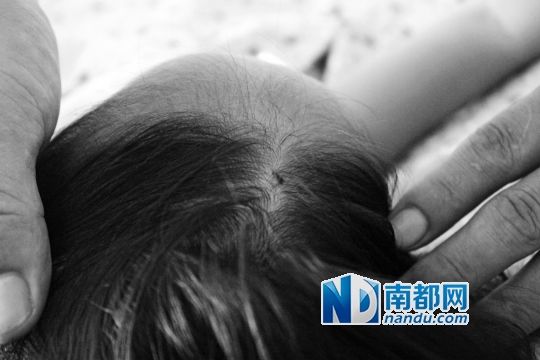 女童頭上被扎的針孔（圓圈處）。賈先生說(shuō)，被扎不到三秒鐘，女兒就昏了。