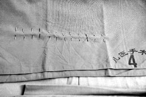 山東女童體內(nèi)12根針成功取出 專家主刀3個半小時 山東女童體內(nèi)12根針成功取出 專家主刀3個半小時