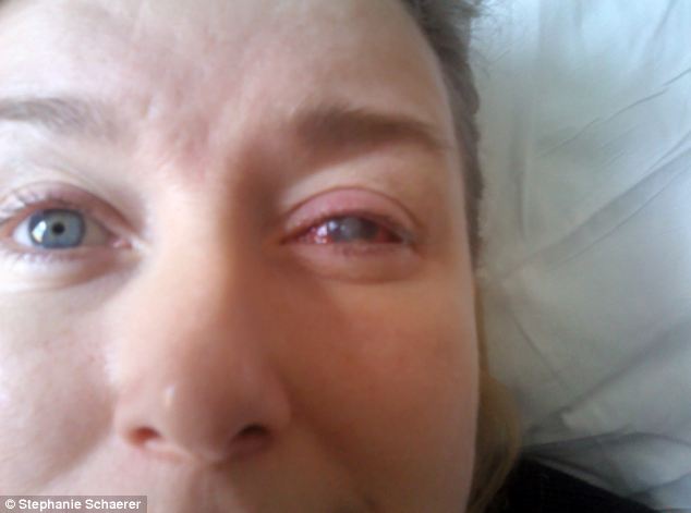 恐怖慎入！隱形眼鏡致英女子摘除眼球