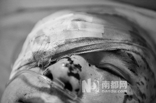李建新頭部還有被潑硫酸的痕跡，醫(yī)生說被砍傷的右眼已經(jīng)失明。 南都記者 田飛 攝