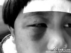 6月2日，網(wǎng)曝渭南市臨渭區(qū)一不滿5歲的女童遭奶奶毆打，眼圈青腫，引起網(wǎng)友關(guān)注，但孩子父母和爺爺均稱是摔倒導(dǎo)致。相關(guān)部門介入調(diào)查發(fā)現(xiàn)確為奶奶毆打所致，鑒于其身體原因已進(jìn)行批評(píng)教育。