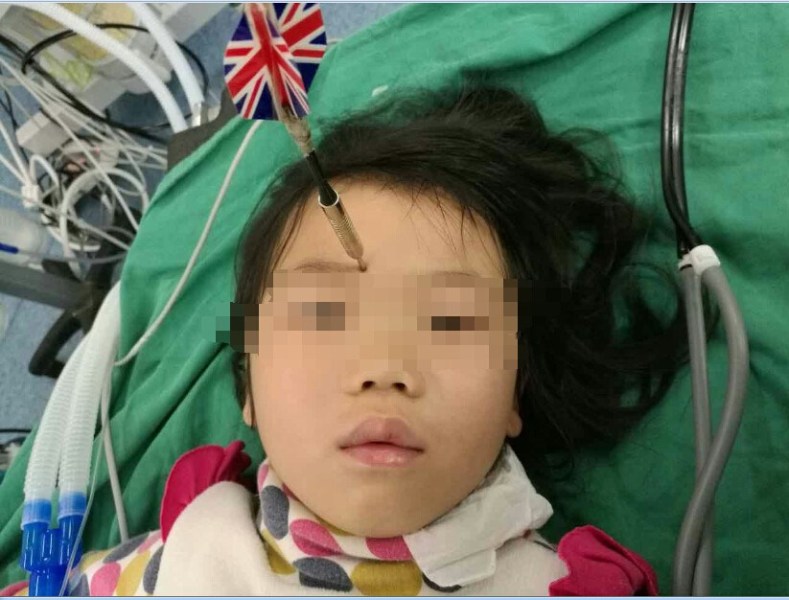十多公分長的飛鏢穩(wěn)穩(wěn)地 ” 定 ” 在了一名六歲半的女童額頭上，小青一家人凌晨從長順趕到貴醫(yī)附院急診室時，看到如此慘烈的情況，接診醫(yī)生都嚇了一跳。詳細詢問下得知，原來是七歲的哥哥和六歲半的表妹在玩耍時，哥哥不慎將路邊撿來的真飛鏢扎到了妹妹的額頭上。