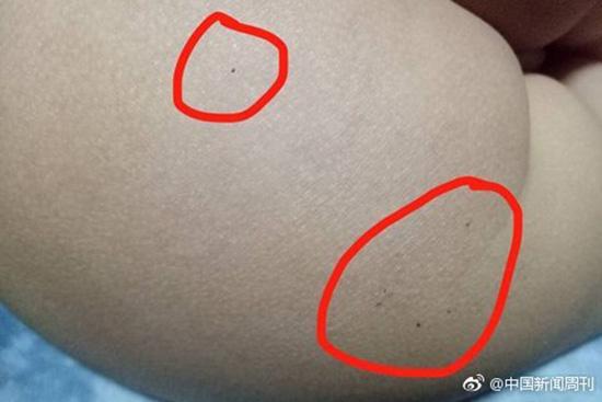 據(jù)多名紅黃藍(lán)(新天地分園)家長反映，孩子腿部、屁股、腋下出現(xiàn)針眼。