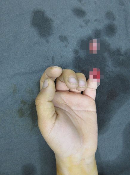 嚇哭！6歲男孩被夾斷手指 罪魁禍?zhǔn)拙故切７? oldsrc=