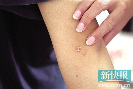 取出針后李星兒手臂留下了傷口。新快報(bào)記者 張國(guó)鋒/攝