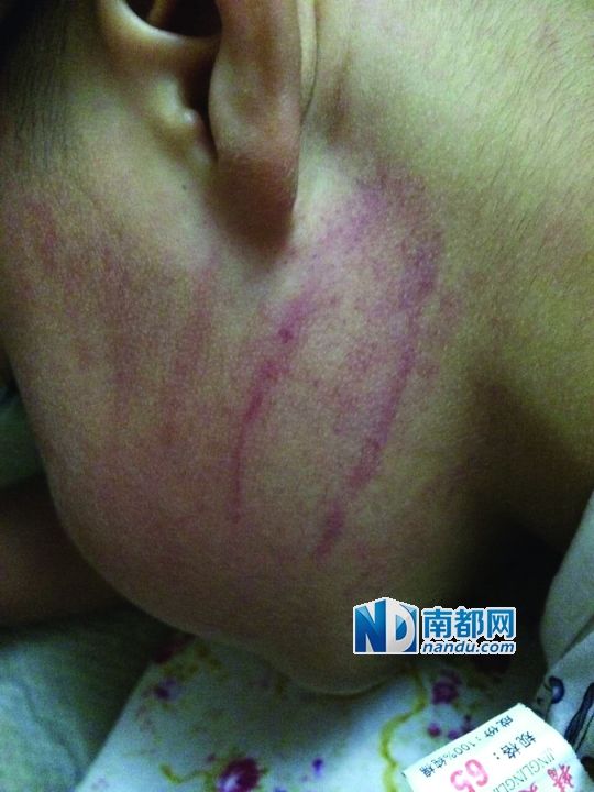小逸臉上淤痕清晰可見(jiàn)。