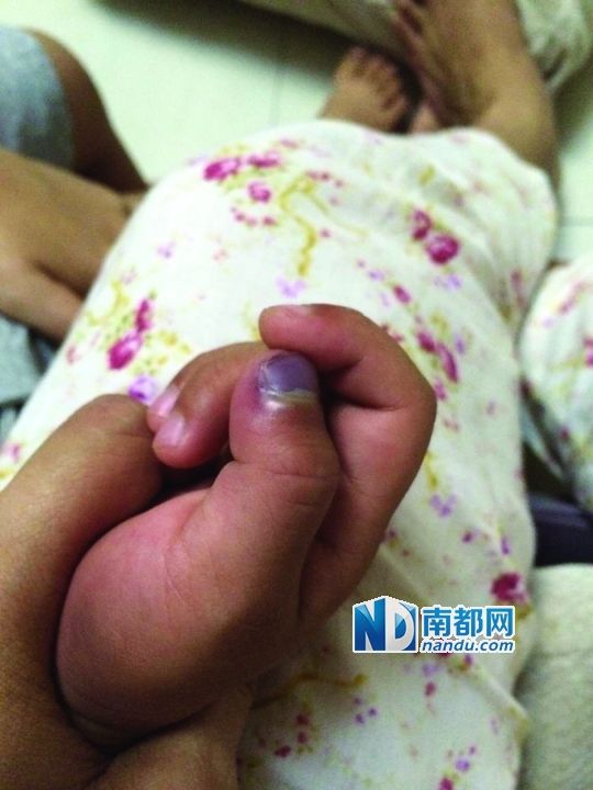 小逸手指被夾傷。
