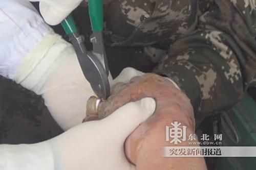 正在拆除戒指。