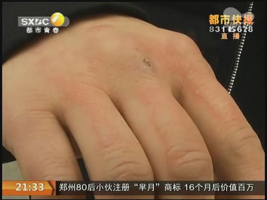 說到這足療拔罐，估計大伙都不陌生，但是想起4號晚上的拔罐的經歷，呂先生現(xiàn)在想起來，還心有余悸。